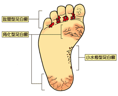 10 5月号 水虫